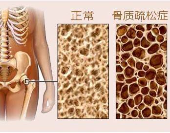 骨密度仪厂家告诉您如何预防骨质疏松性骨折
