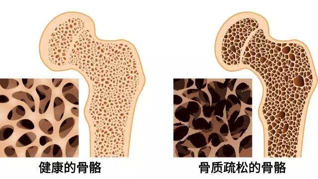 超声骨密度仪检测骨质疏松症，早发现早治疗—山东国康