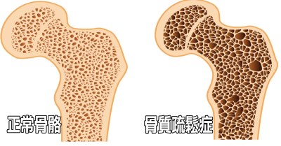便携式骨密度仪之骨质缺钙对不同年龄段人群的影响—山东国康