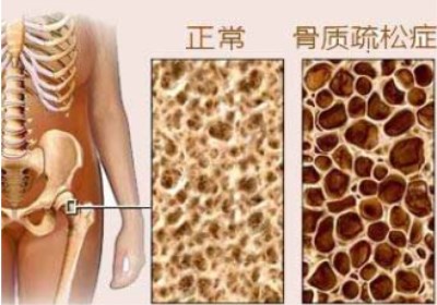 骨密度仪厂家浅谈骨密度下降有信号-山东国康