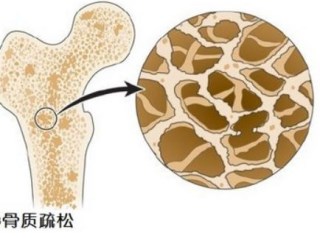 骨密度仪告诉你隐性骨质疏松严重超乎你的想象